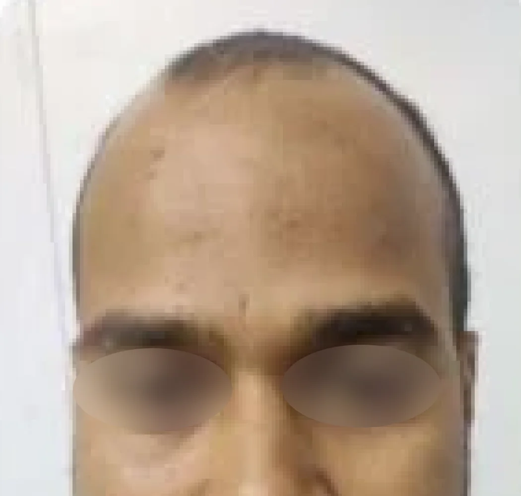 Frontal hairline, before the procedure