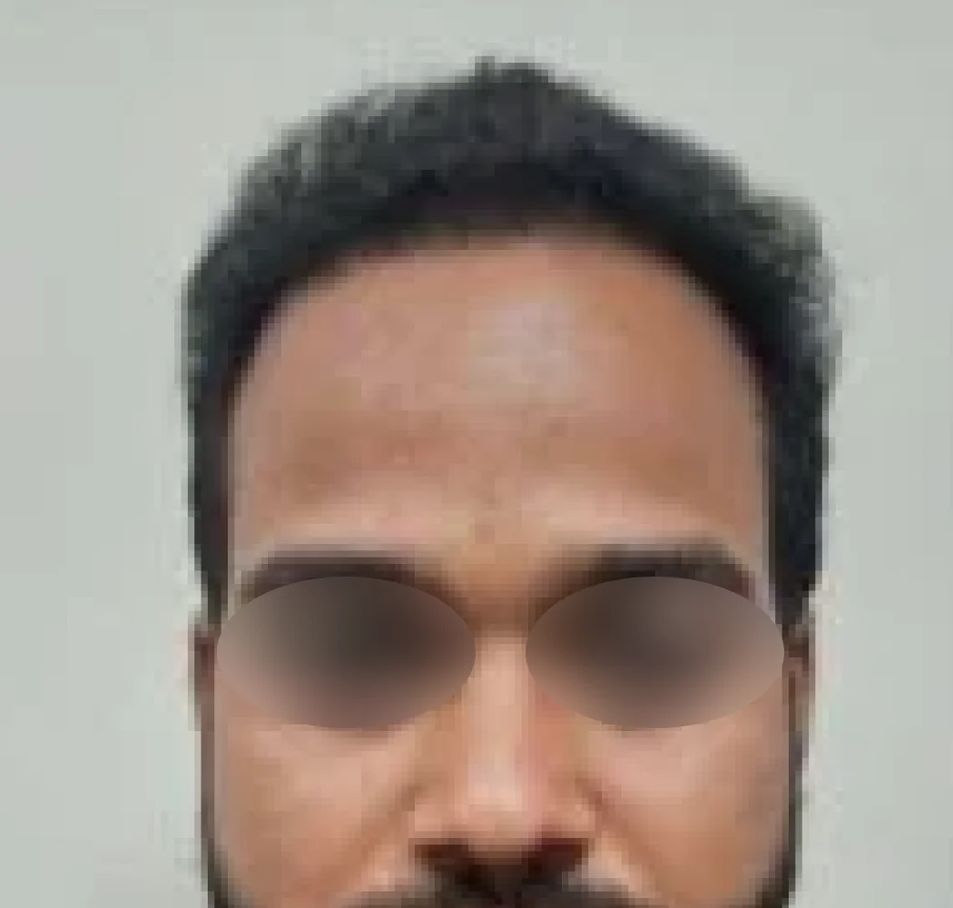 Frontal hairline, after the procedure