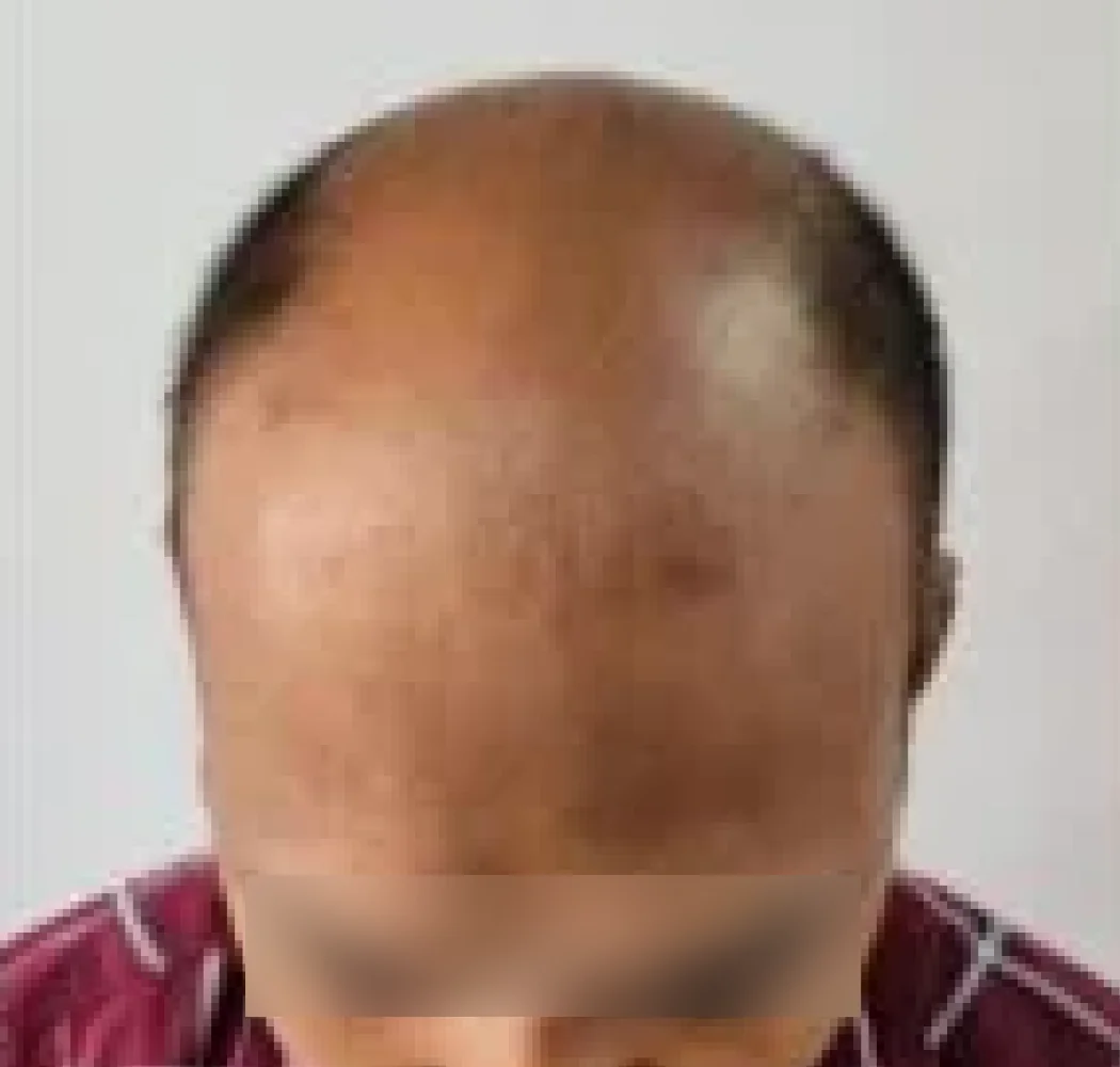 Crown coverage, before the procedure