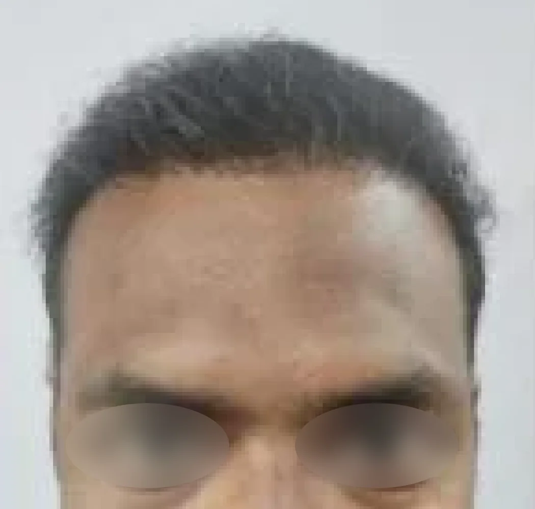 Crown coverage, after the procedure